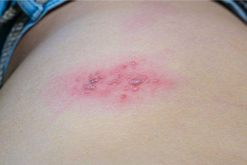 herpes zoster en CDMX