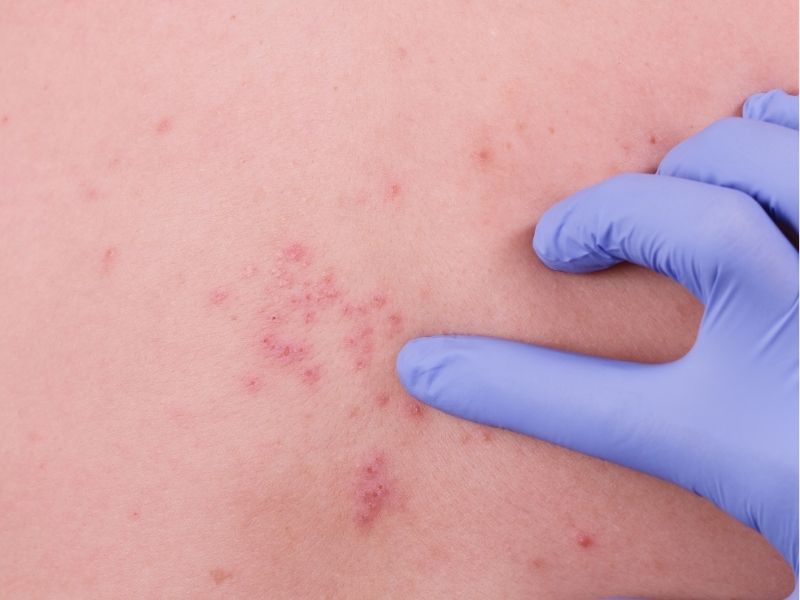 Herpes zoster en CDMX